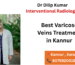 Best Varicose Veins Treatment in Kannur