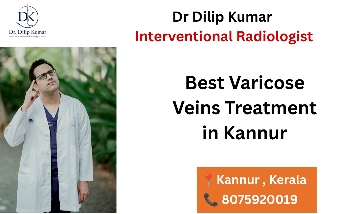 Best Varicose Veins Treatment in Kannur